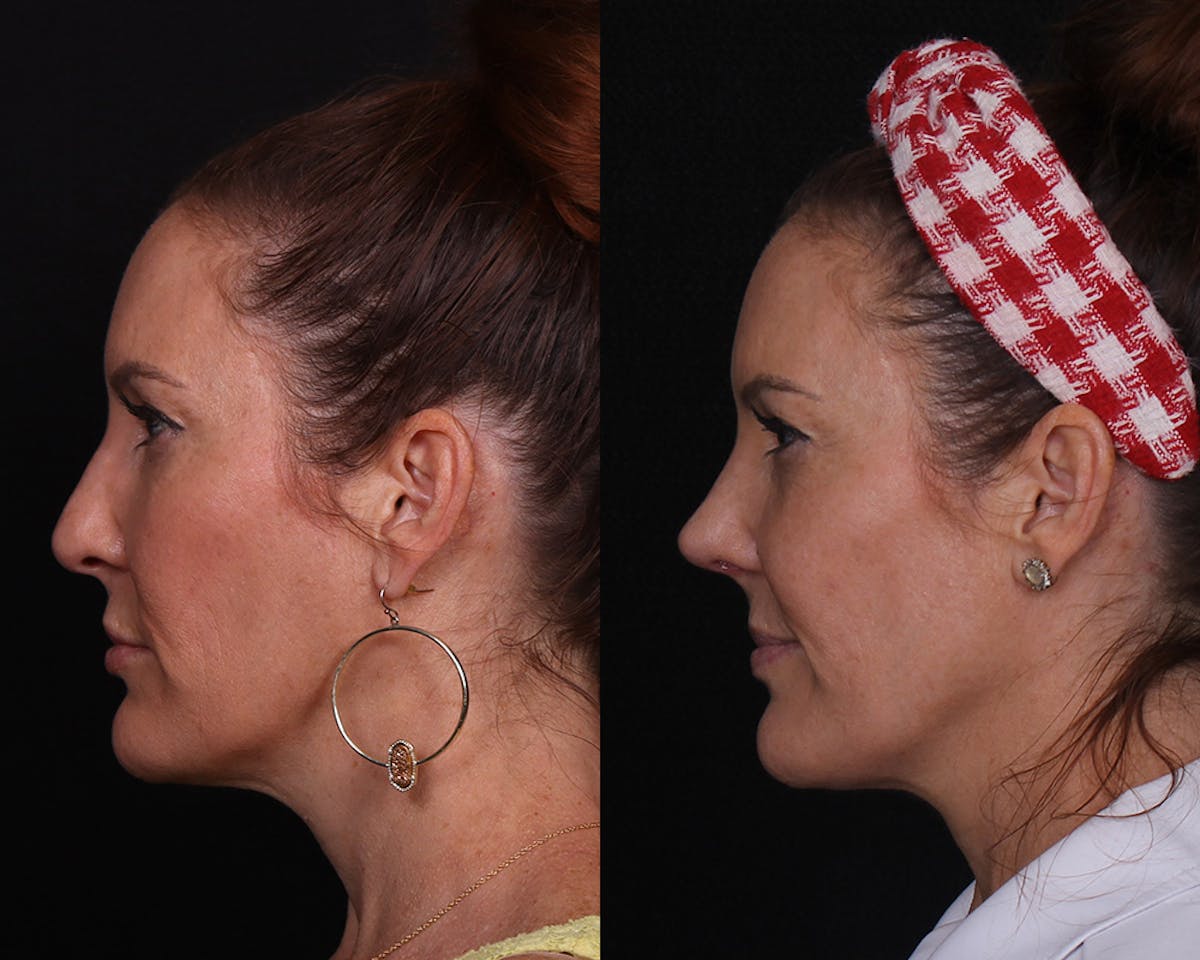 Rhinoplasty Female Before & After Gallery - Patient 234921 - Image 5