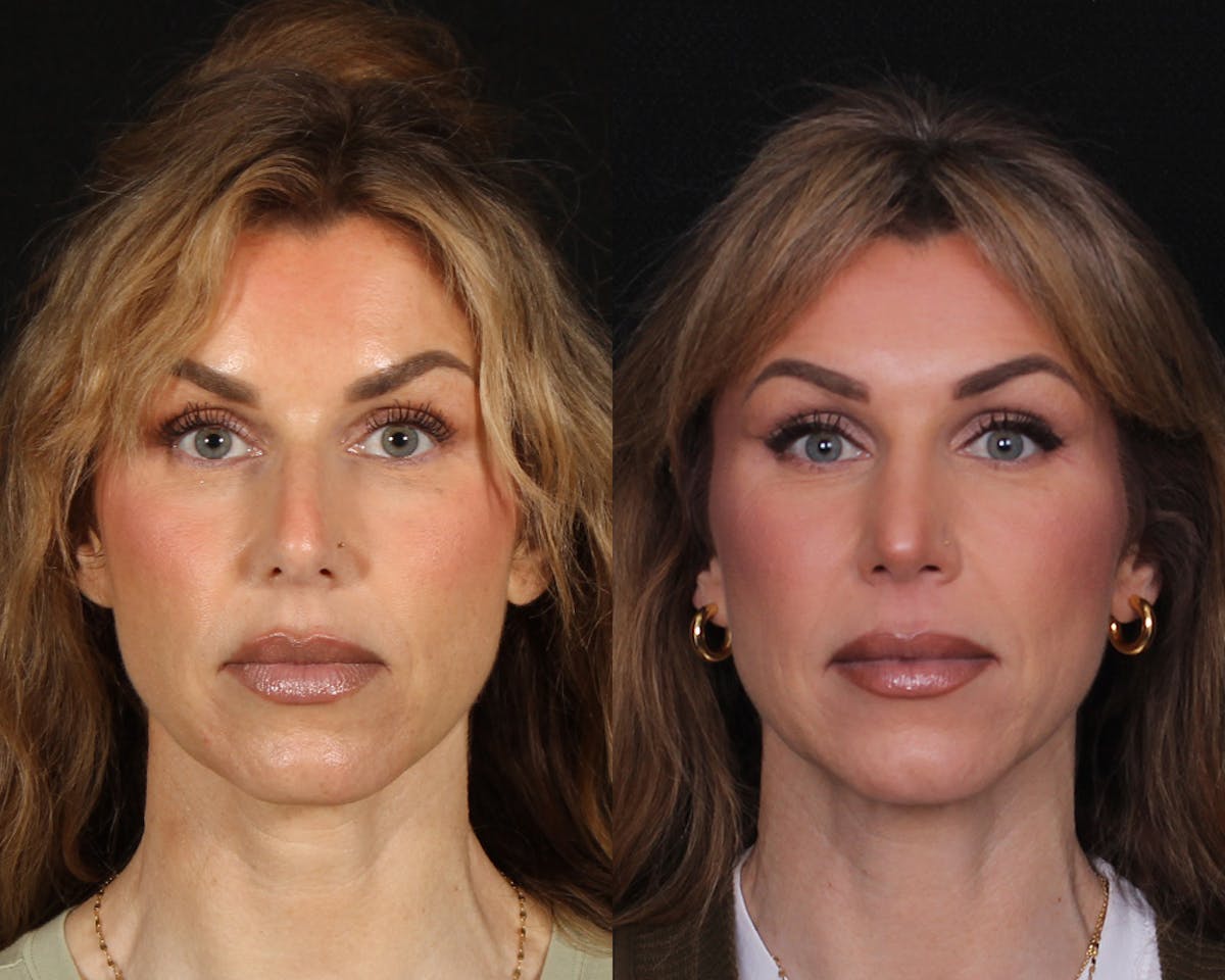 Rhinoplasty Female Before & After Gallery - Patient 510986 - Image 3
