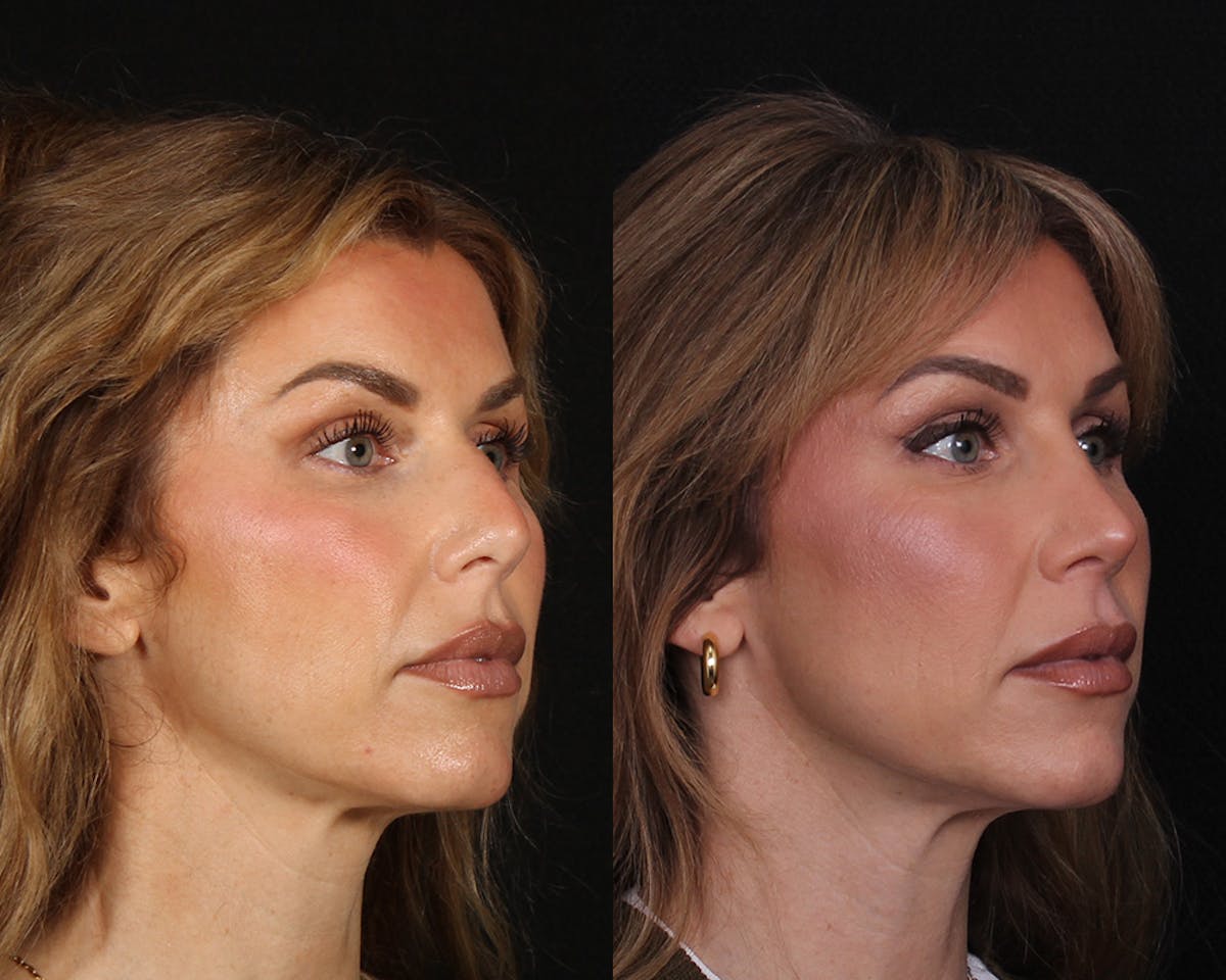 Rhinoplasty Female Before & After Gallery - Patient 510986 - Image 4