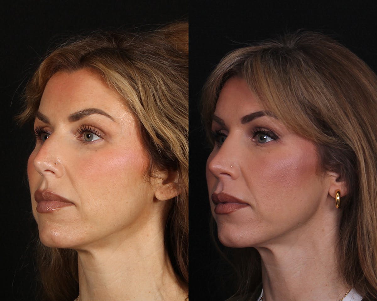 Rhinoplasty Female Before & After Gallery - Patient 510986 - Image 2