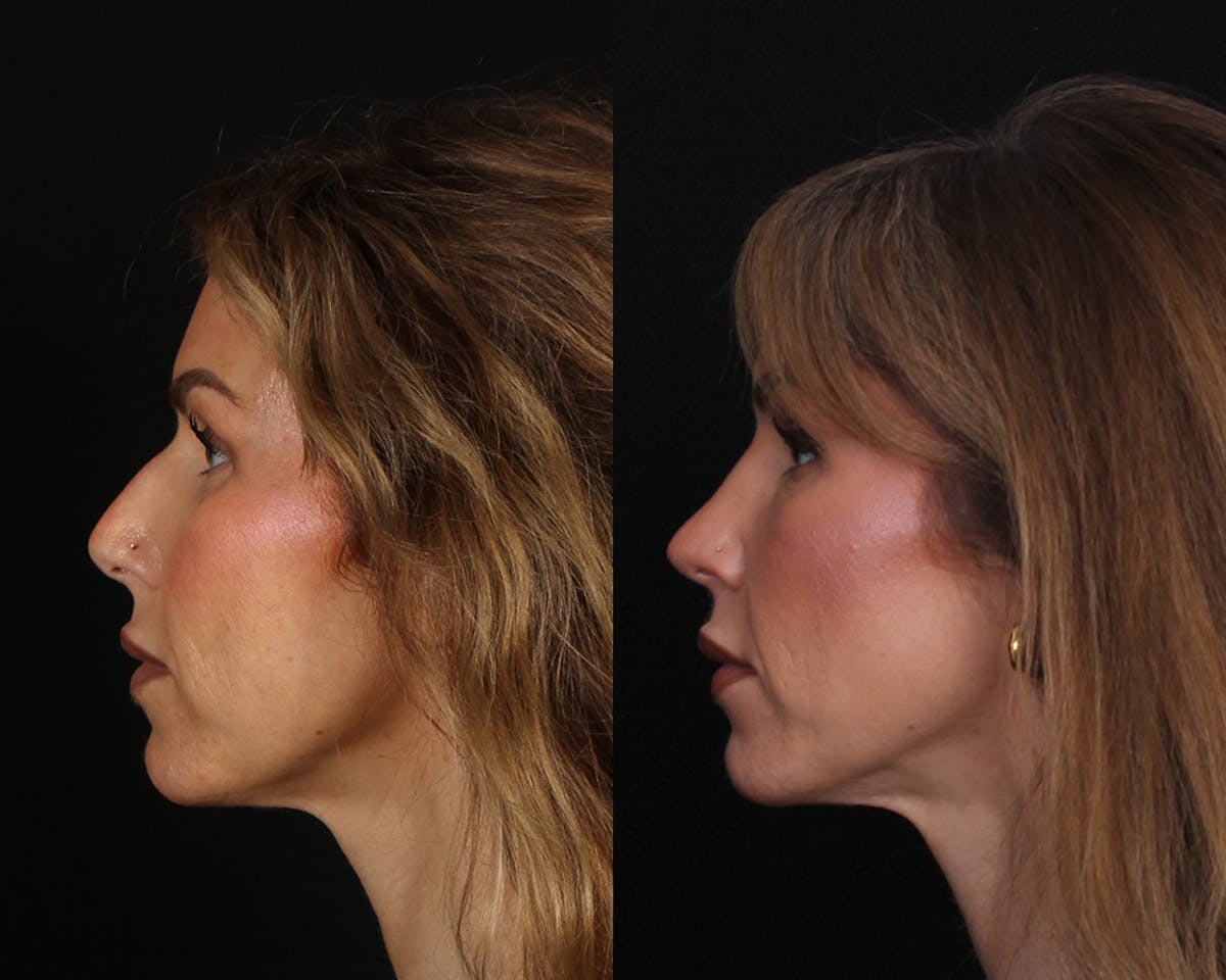 Rhinoplasty Female Before & After Gallery - Patient 510986 - Image 1