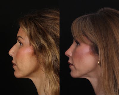 Rhinoplasty Female Before & After Gallery - Patient 510986 - Image 1