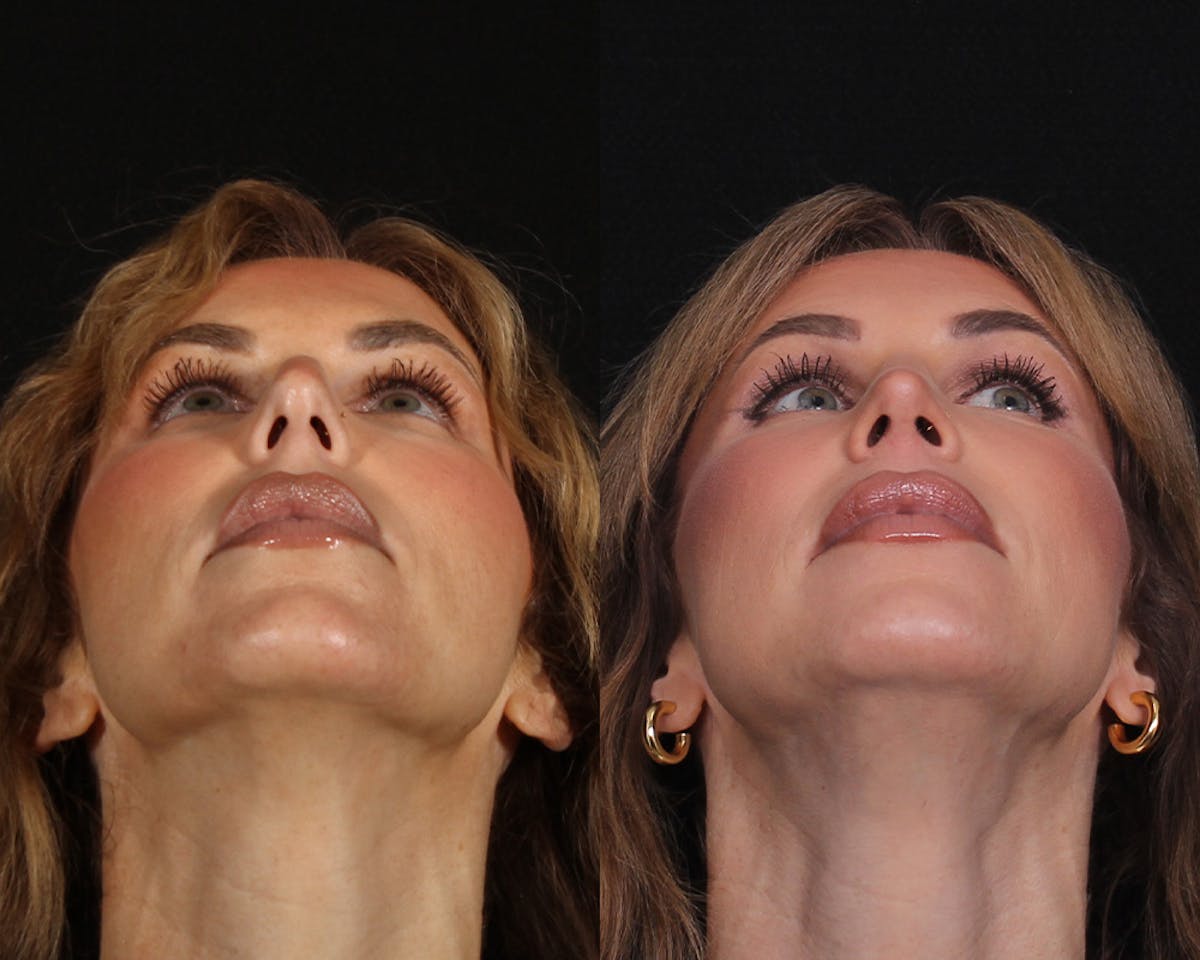Rhinoplasty Female Before & After Gallery - Patient 510986 - Image 5