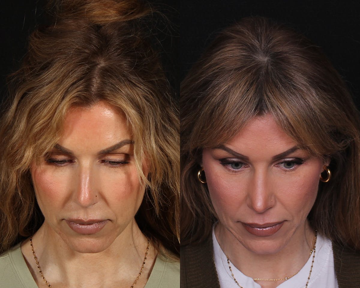 Rhinoplasty Female Before & After Gallery - Patient 510986 - Image 6