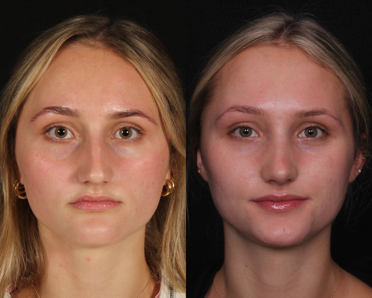 Rhinoplasty Female Before & After Gallery - Patient 271188 - Image 3
