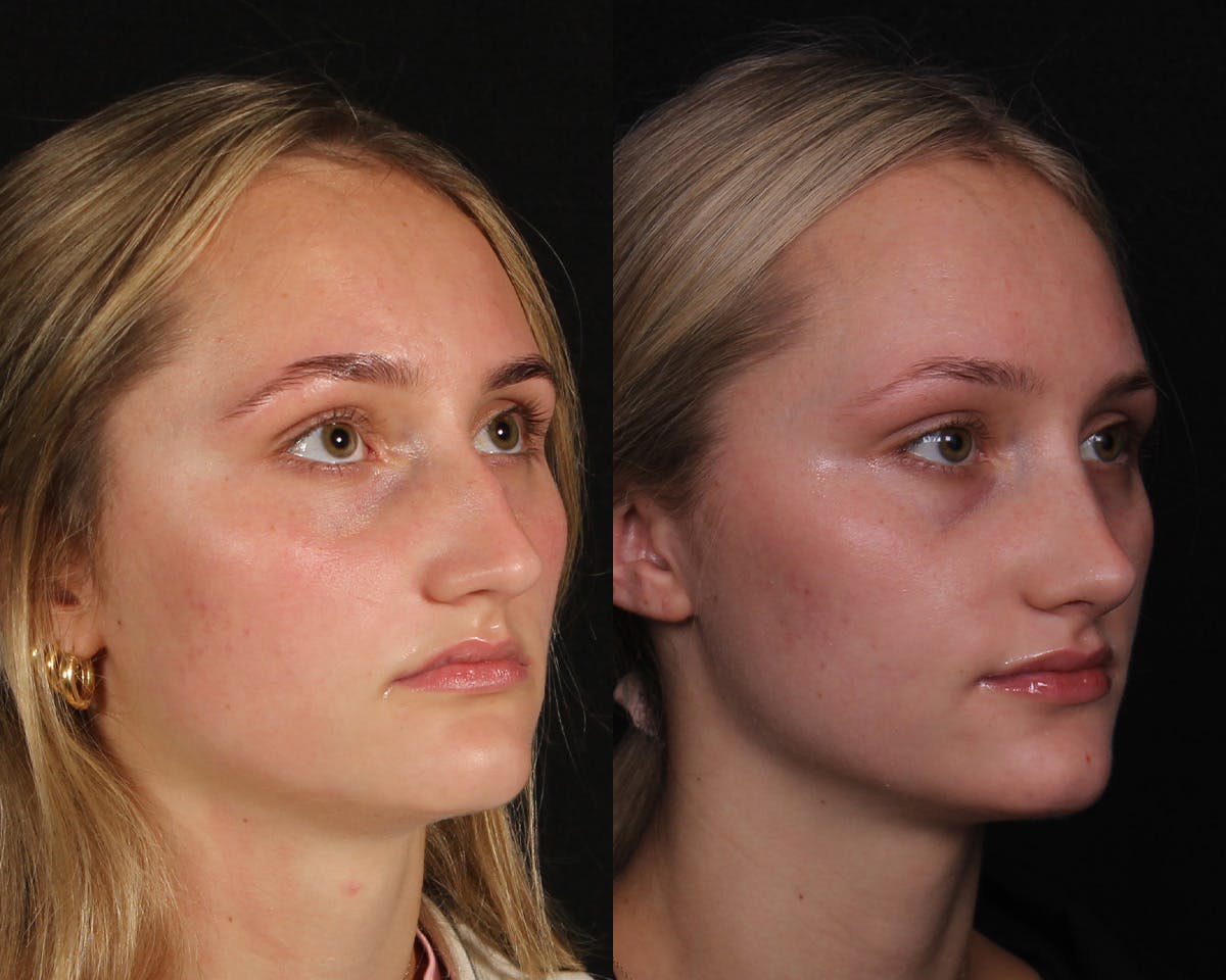 Rhinoplasty Female Before & After Gallery - Patient 271188 - Image 4