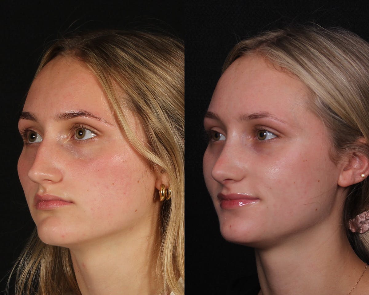 Rhinoplasty Female Before & After Gallery - Patient 271188 - Image 2