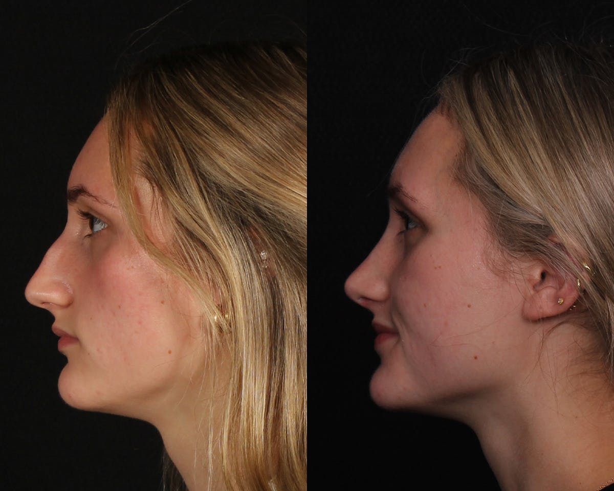 Rhinoplasty Female Before & After Gallery - Patient 271188 - Image 1