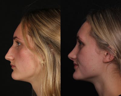 Rhinoplasty Female Before & After Gallery - Patient 271188 - Image 1