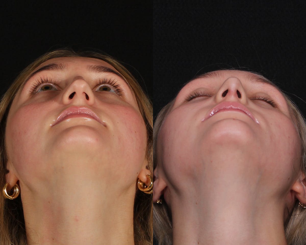 Rhinoplasty Female Before & After Gallery - Patient 271188 - Image 5