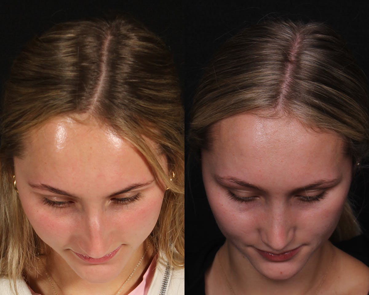 Rhinoplasty Female Before & After Gallery - Patient 271188 - Image 6