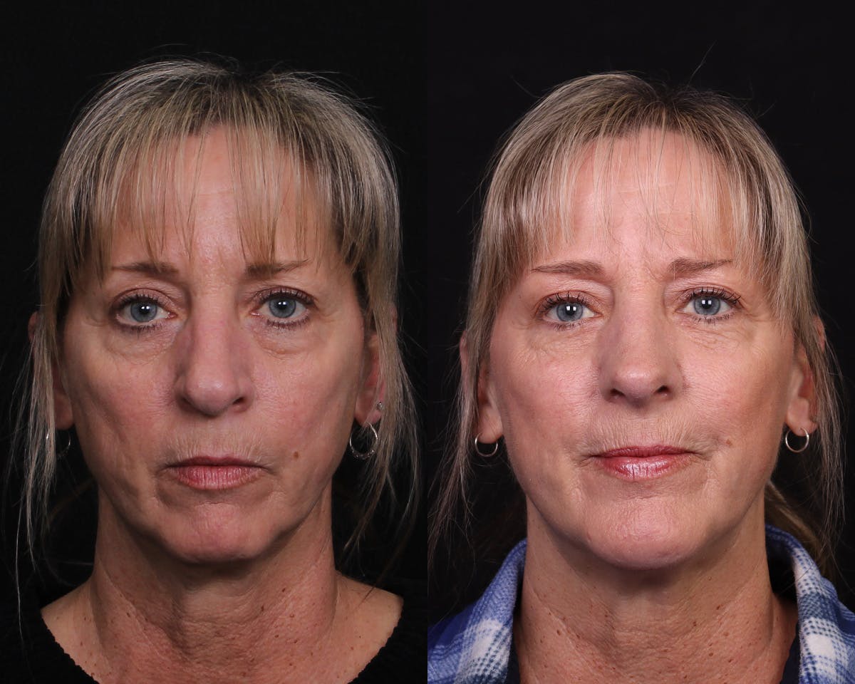 Rhinoplasty Female Before & After Gallery - Patient 364021 - Image 3