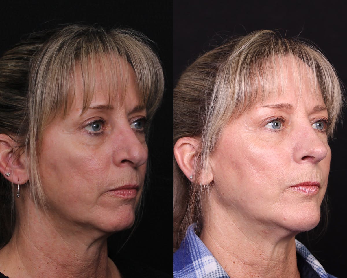 Rhinoplasty Female Before & After Gallery - Patient 364021 - Image 4