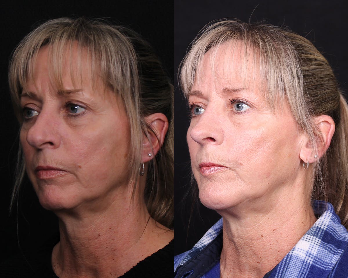 Rhinoplasty Female Before & After Gallery - Patient 364021 - Image 2
