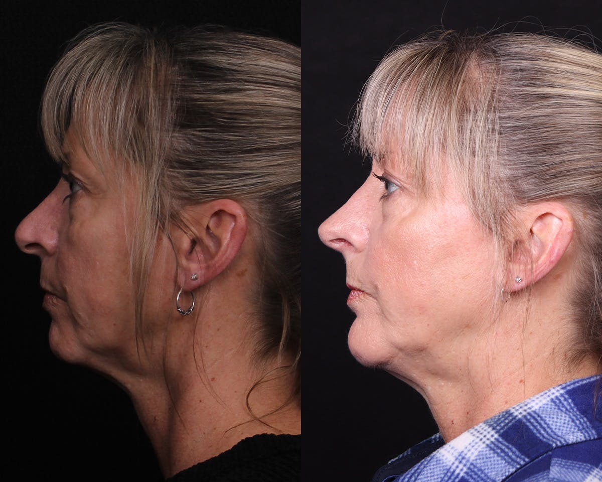 Rhinoplasty Female Before & After Gallery - Patient 364021 - Image 1