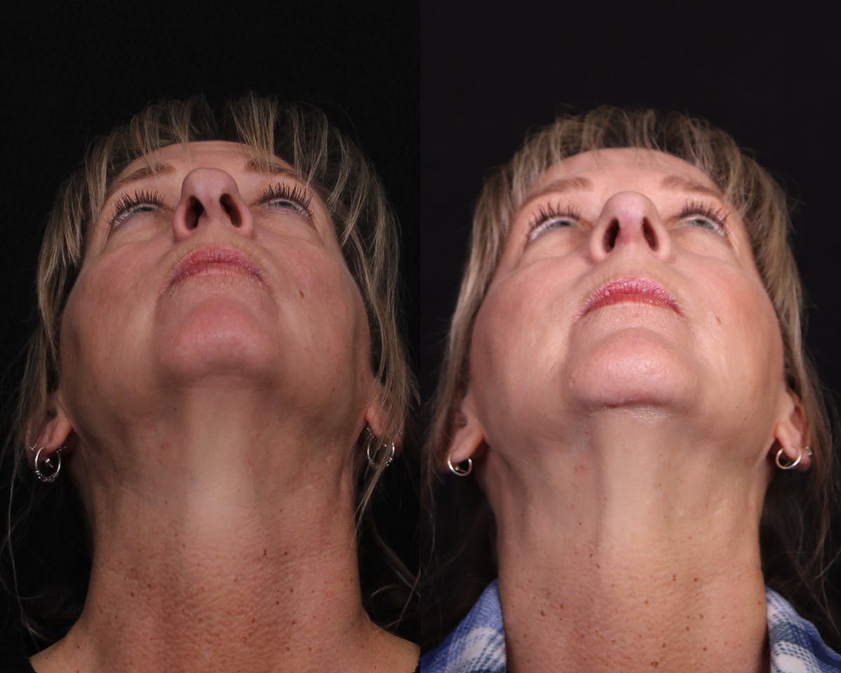 Rhinoplasty Female Before & After Gallery - Patient 364021 - Image 6