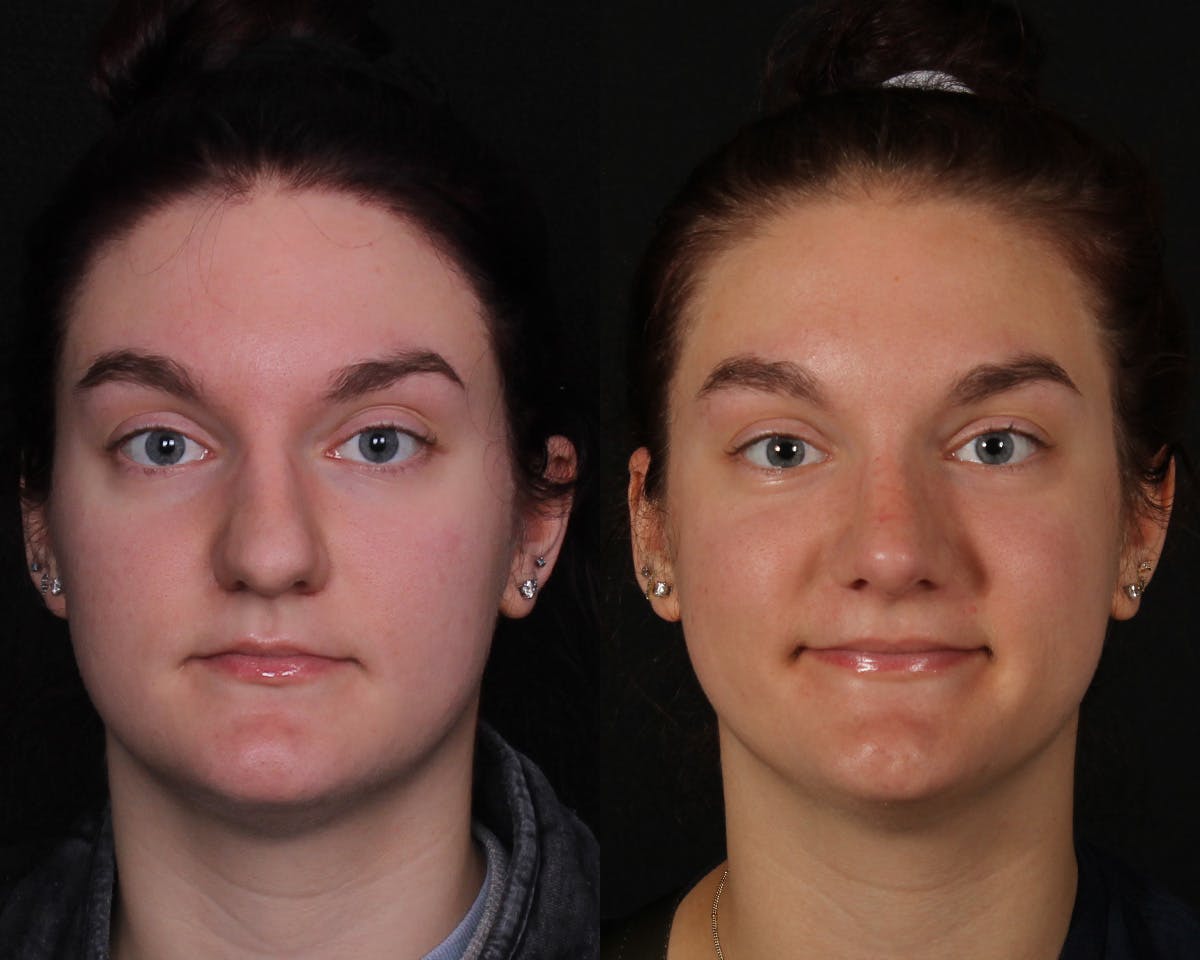 Rhinoplasty Female Before & After Gallery - Patient 146332 - Image 3