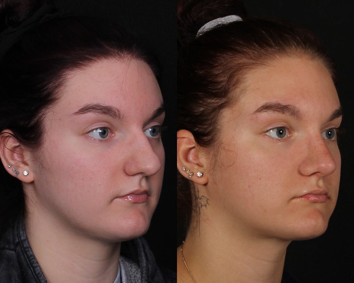 Rhinoplasty Female Before & After Gallery - Patient 146332 - Image 2