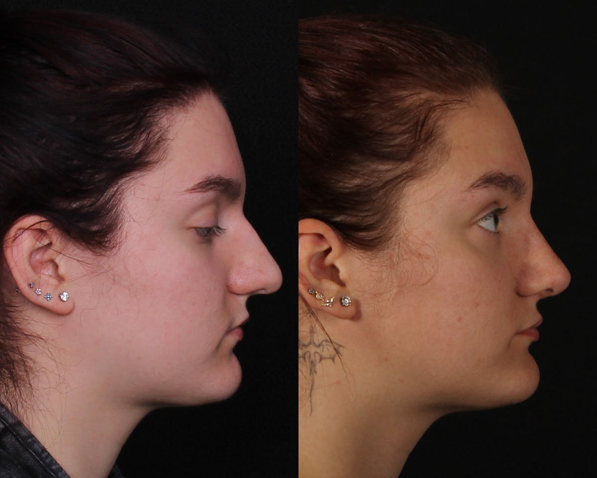 Rhinoplasty Female Before & After Gallery - Patient 146332 - Image 1