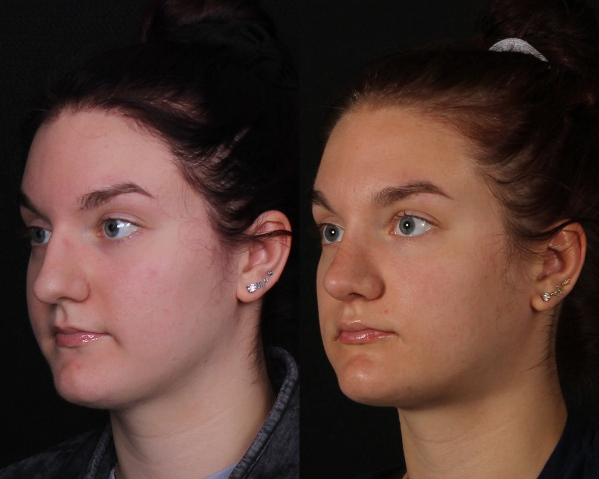 Rhinoplasty Female Before & After Gallery - Patient 146332 - Image 4