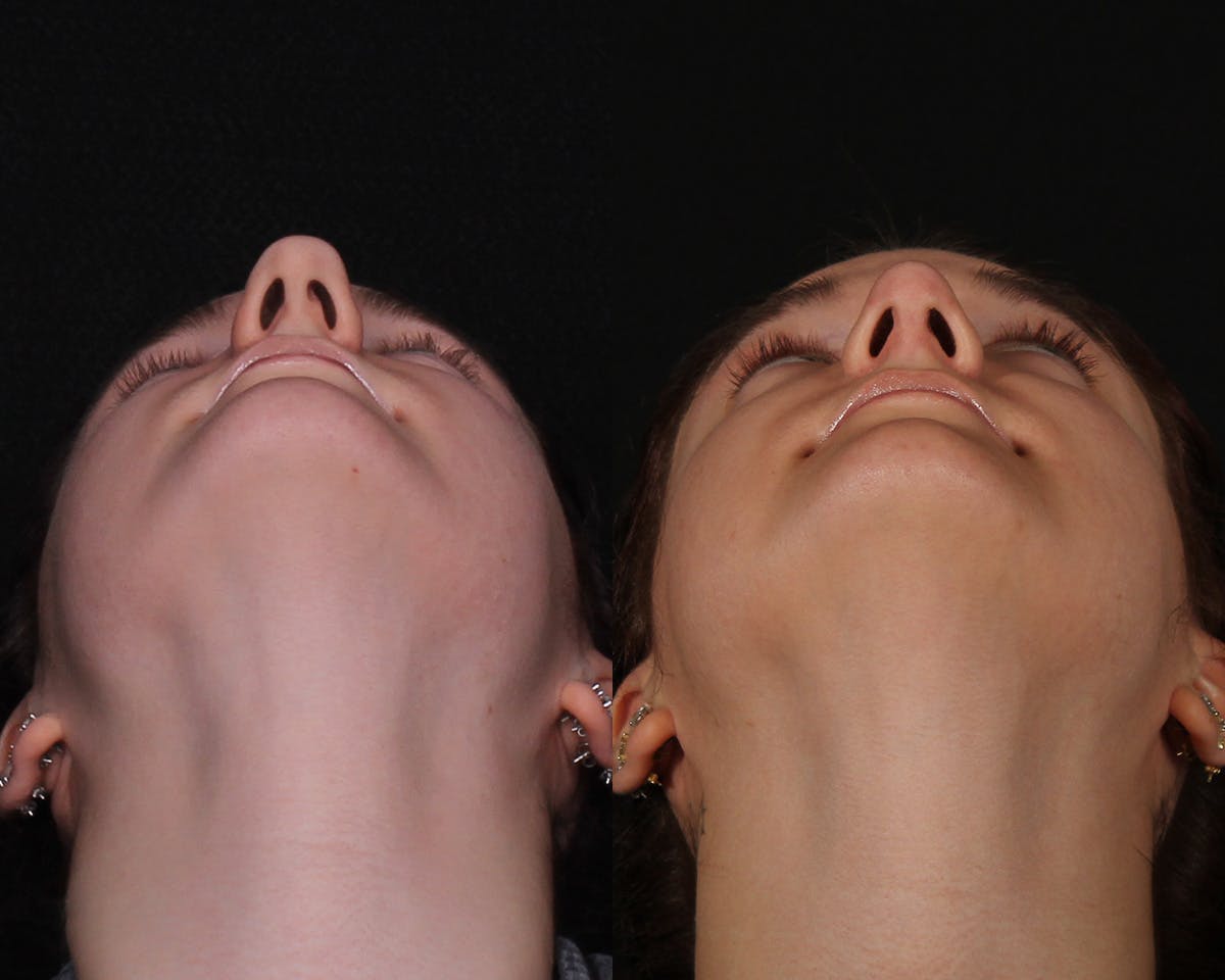 Rhinoplasty Female Before & After Gallery - Patient 146332 - Image 5