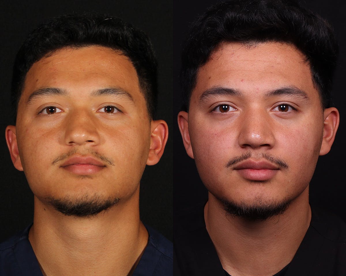 Rhinoplasty Male Before & After Gallery - Patient 364772 - Image 3