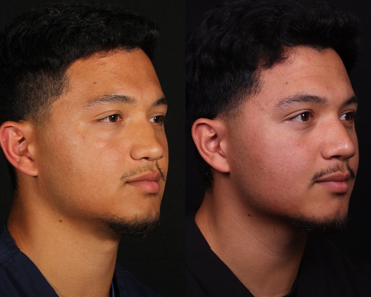 Rhinoplasty Male Before & After Gallery - Patient 364772 - Image 2
