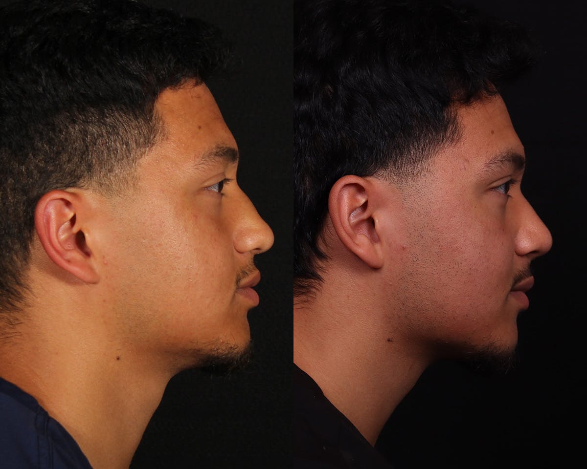 Rhinoplasty Male Before & After Gallery - Patient 364772 - Image 1