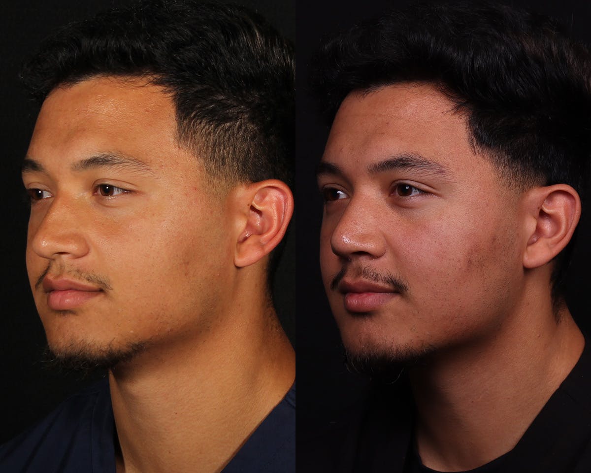 Rhinoplasty Male Before & After Gallery - Patient 364772 - Image 4