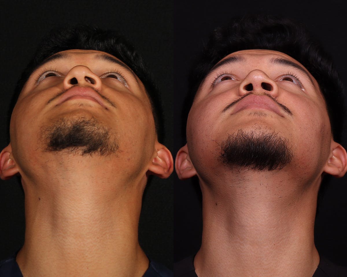 Rhinoplasty Male Before & After Gallery - Patient 364772 - Image 6