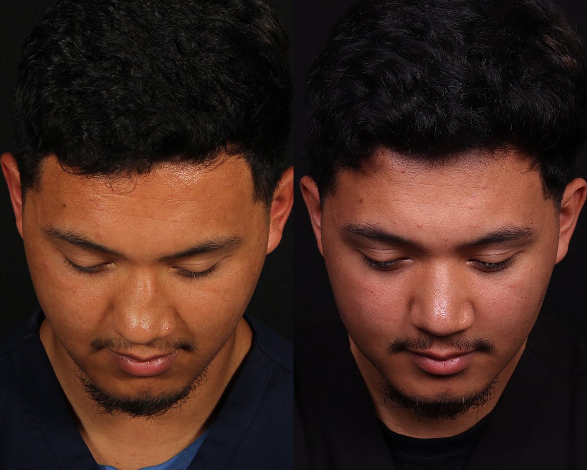 Rhinoplasty Male Before & After Gallery - Patient 364772 - Image 7