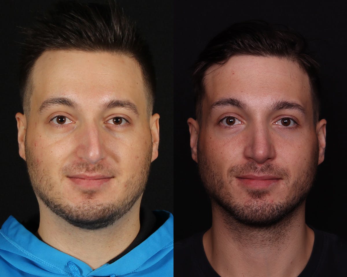 Rhinoplasty Male Before & After Gallery - Patient 424289 - Image 3