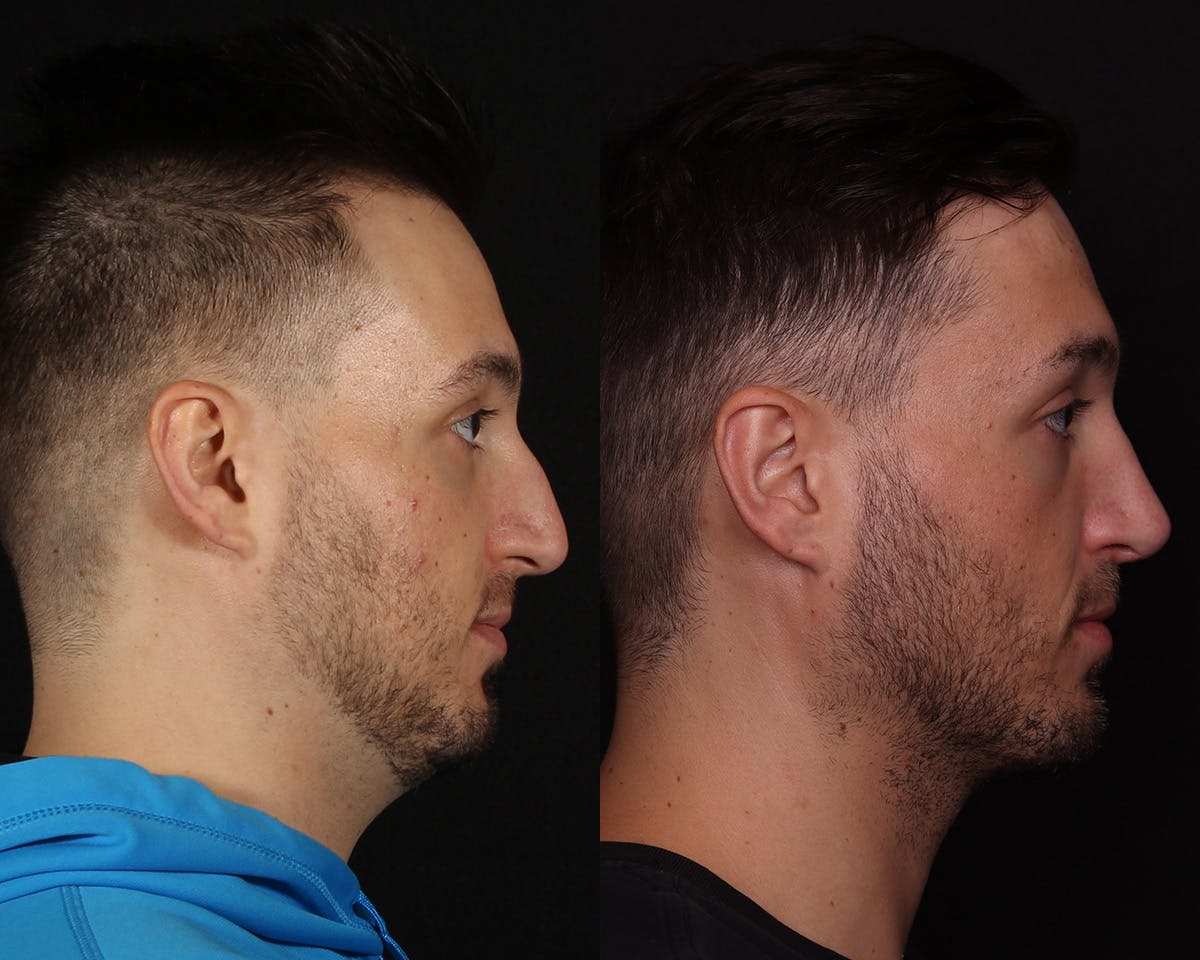 Rhinoplasty Male Before & After Gallery - Patient 424289 - Image 1