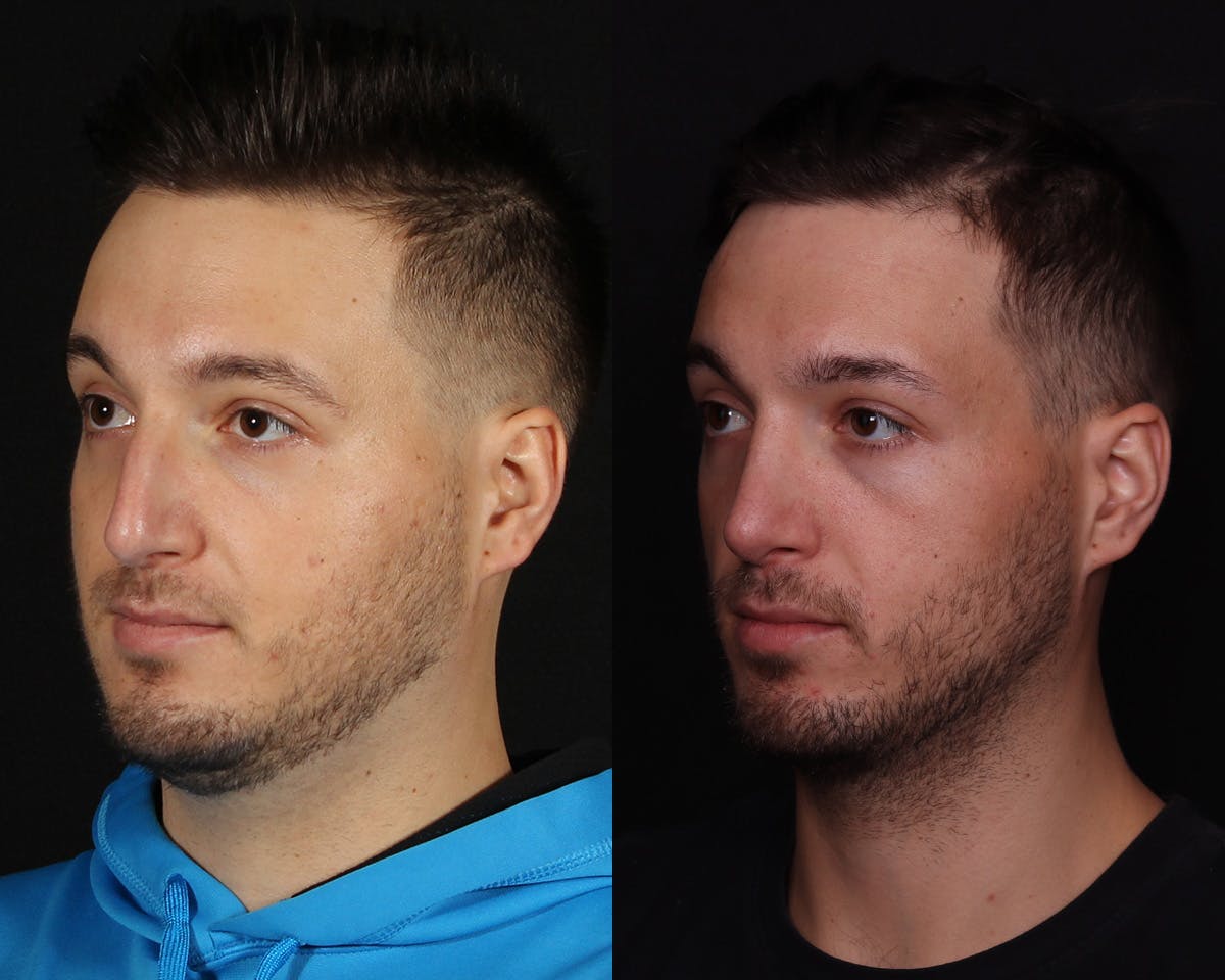 Rhinoplasty Male Before & After Gallery - Patient 424289 - Image 2