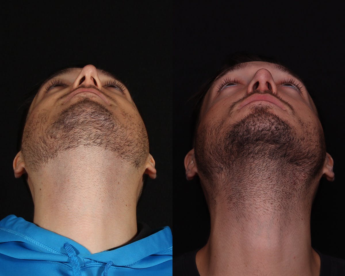 Rhinoplasty Male Before & After Gallery - Patient 424289 - Image 4
