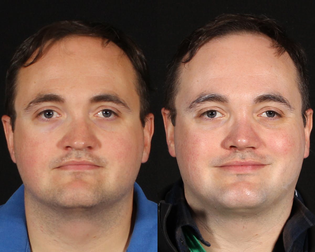 Rhinoplasty Male Before & After Gallery - Patient 314174 - Image 3