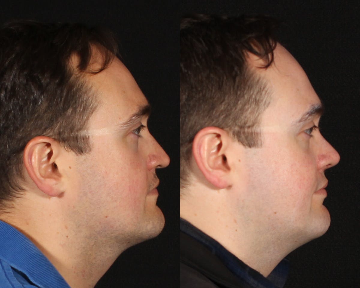 Rhinoplasty Male Before & After Gallery - Patient 314174 - Image 1