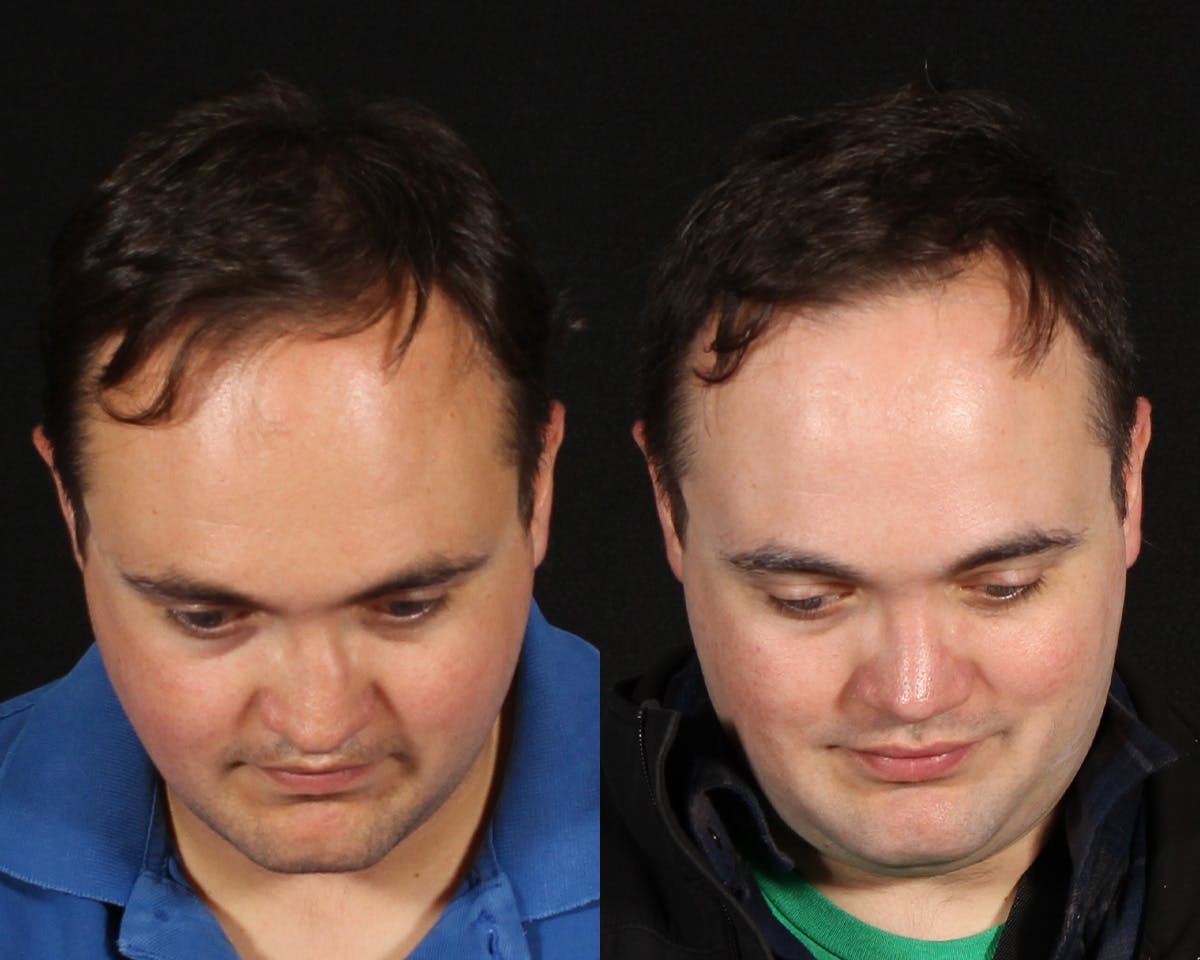 Rhinoplasty Male Before & After Gallery - Patient 314174 - Image 4