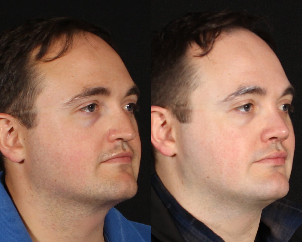 Rhinoplasty Male Before & After Gallery - Patient 314174 - Image 2