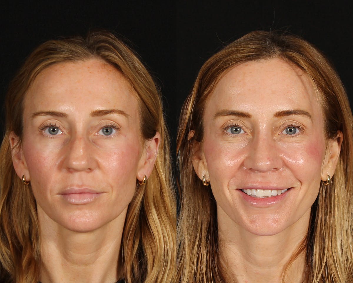Rhinoplasty Revision Before & After Gallery - Patient 615673 - Image 3