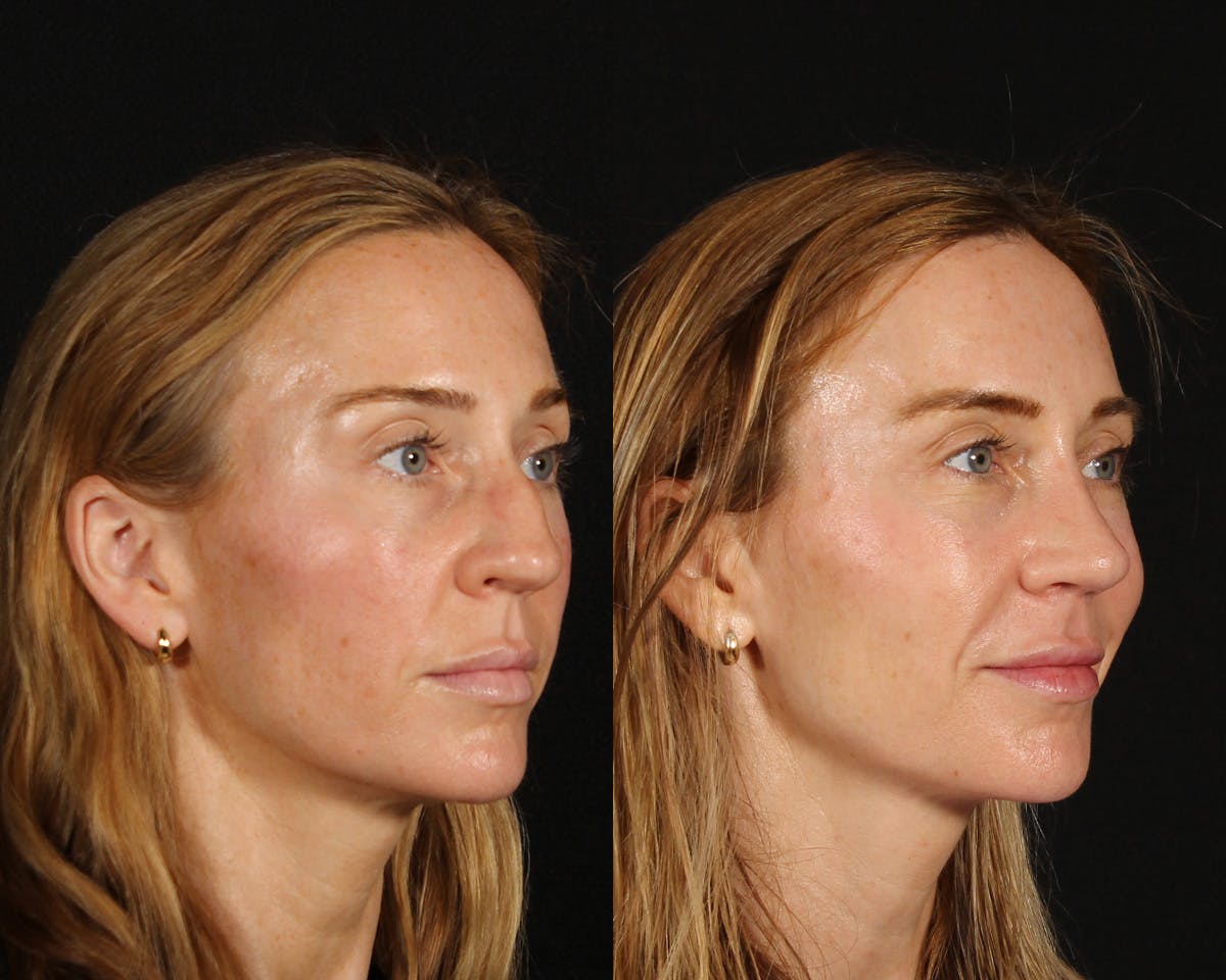 Rhinoplasty Revision Before & After Gallery - Patient 615673 - Image 2
