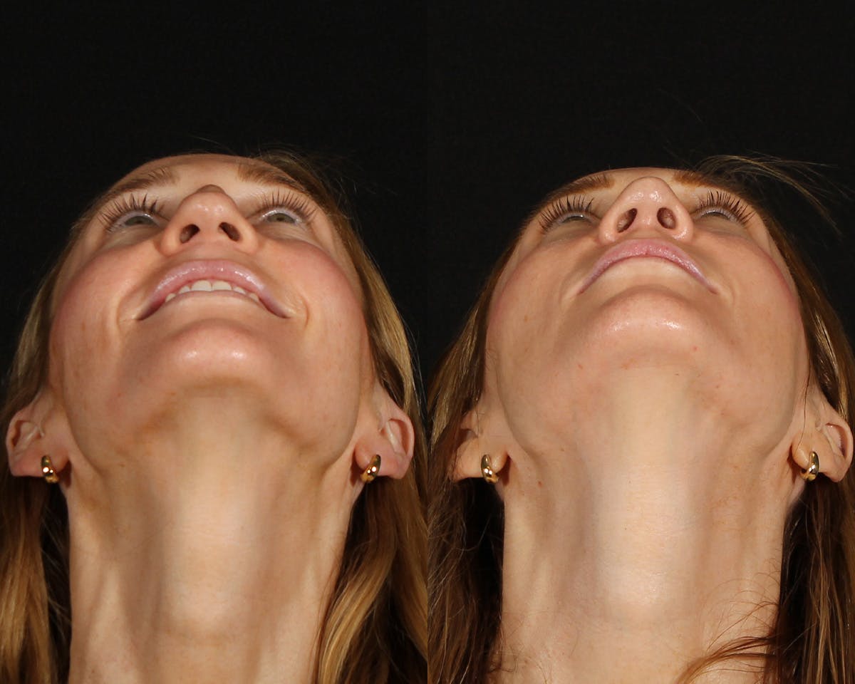 Rhinoplasty Revision Before & After Gallery - Patient 615673 - Image 6