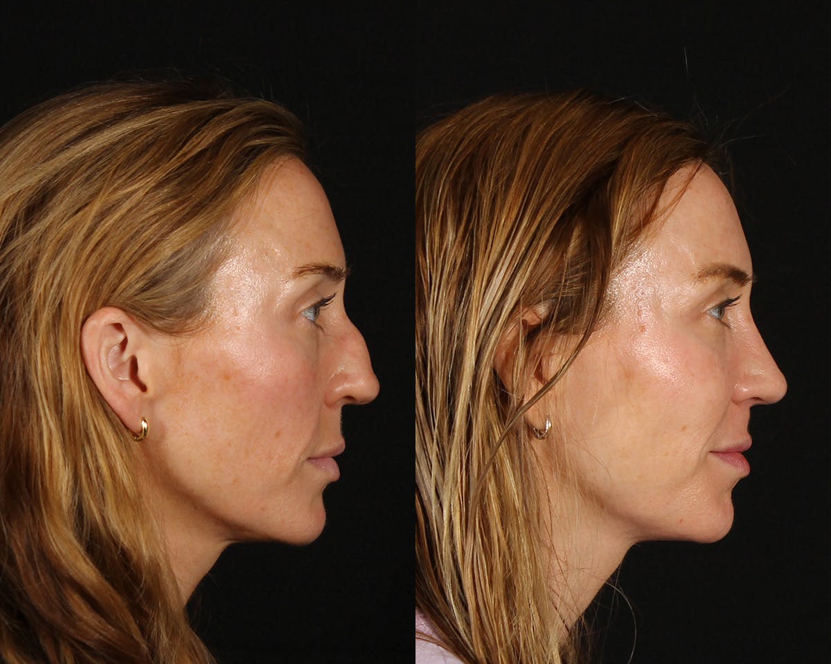 Rhinoplasty Revision Before & After Gallery - Patient 615673 - Image 1