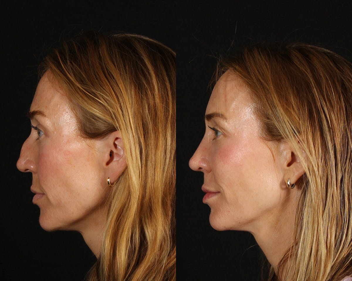 Rhinoplasty Revision Before & After Gallery - Patient 615673 - Image 4