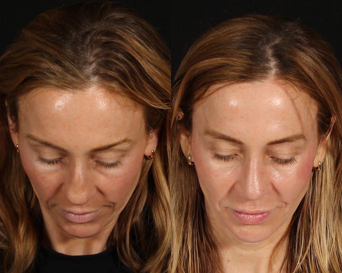 Rhinoplasty Revision Before & After Gallery - Patient 615673 - Image 5