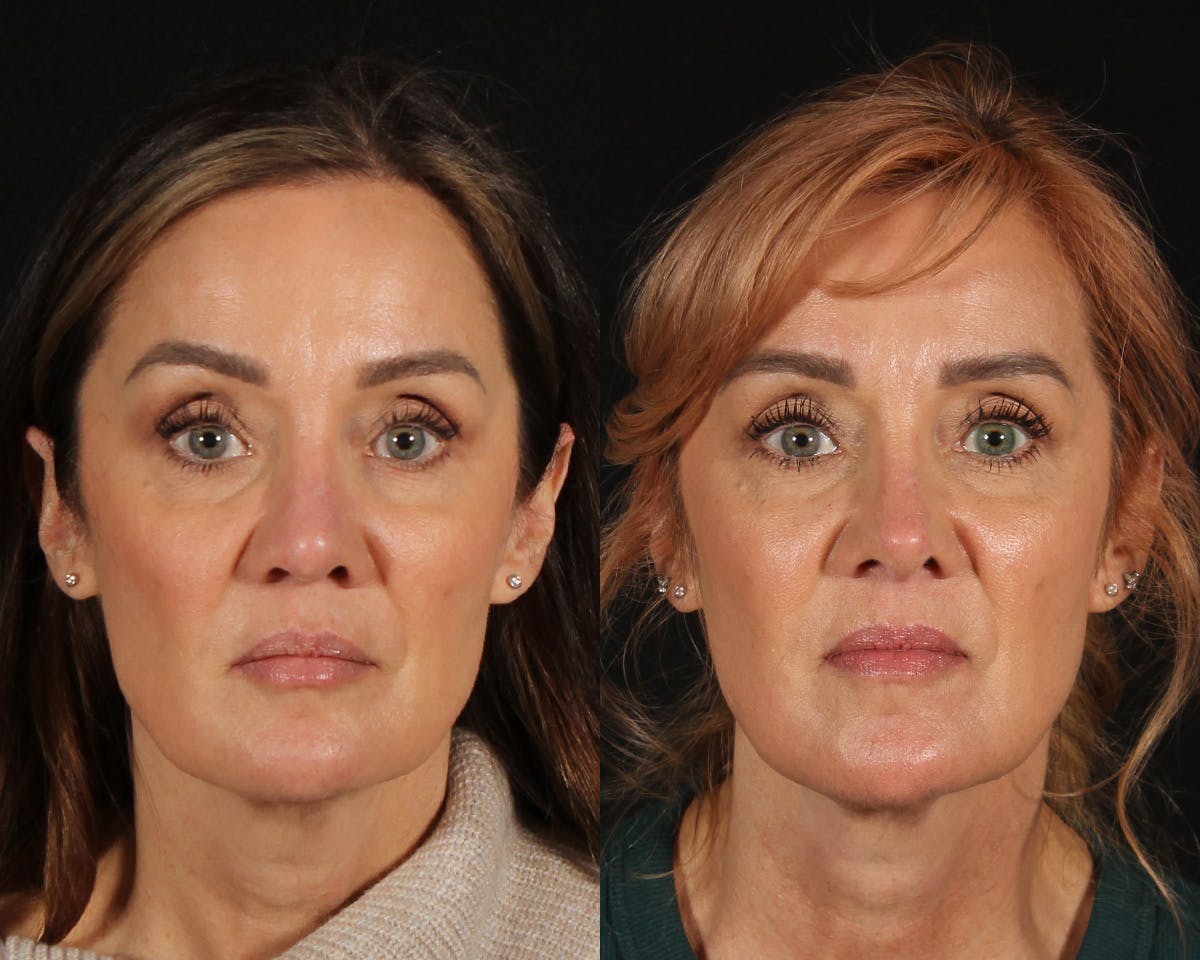 Rhinoplasty Revision Before & After Gallery - Patient 426901 - Image 3