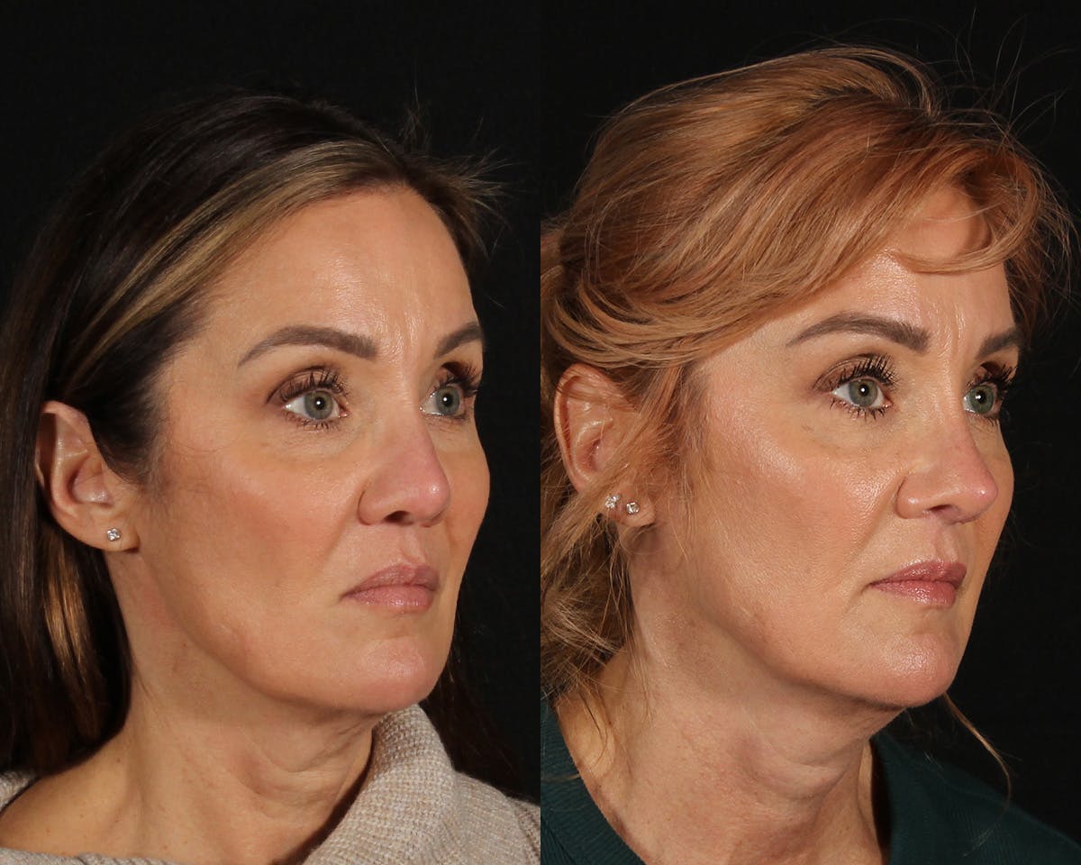 Rhinoplasty Revision Before & After Gallery - Patient 426901 - Image 2