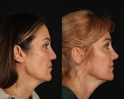 Rhinoplasty Revision Before & After Gallery - Patient 426901 - Image 1