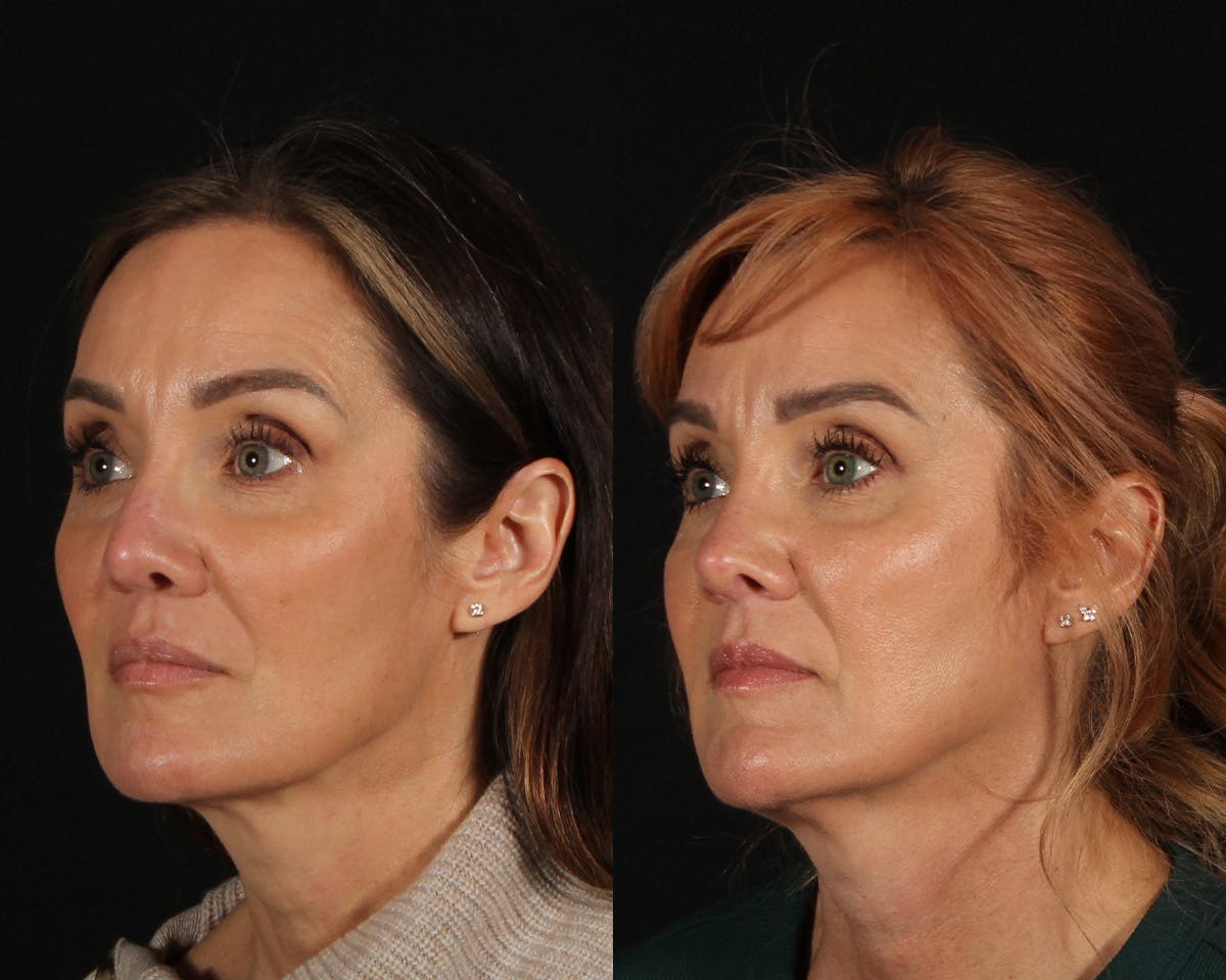 Rhinoplasty Revision Before & After Gallery - Patient 426901 - Image 4