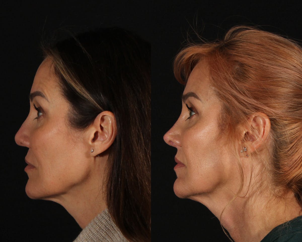 Rhinoplasty Revision Before & After Gallery - Patient 426901 - Image 5